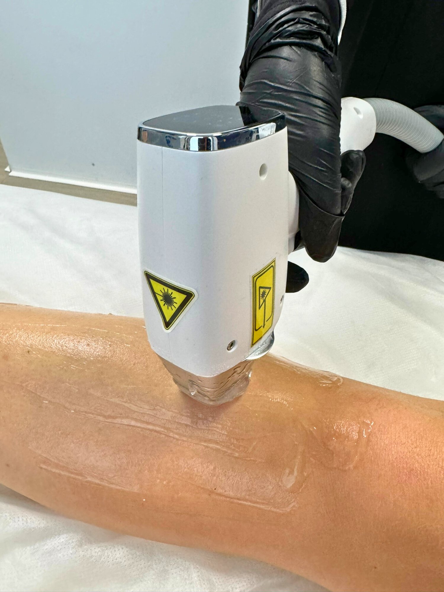 Infirmière pratiquant l'épilation laser diode — décret 2024-470