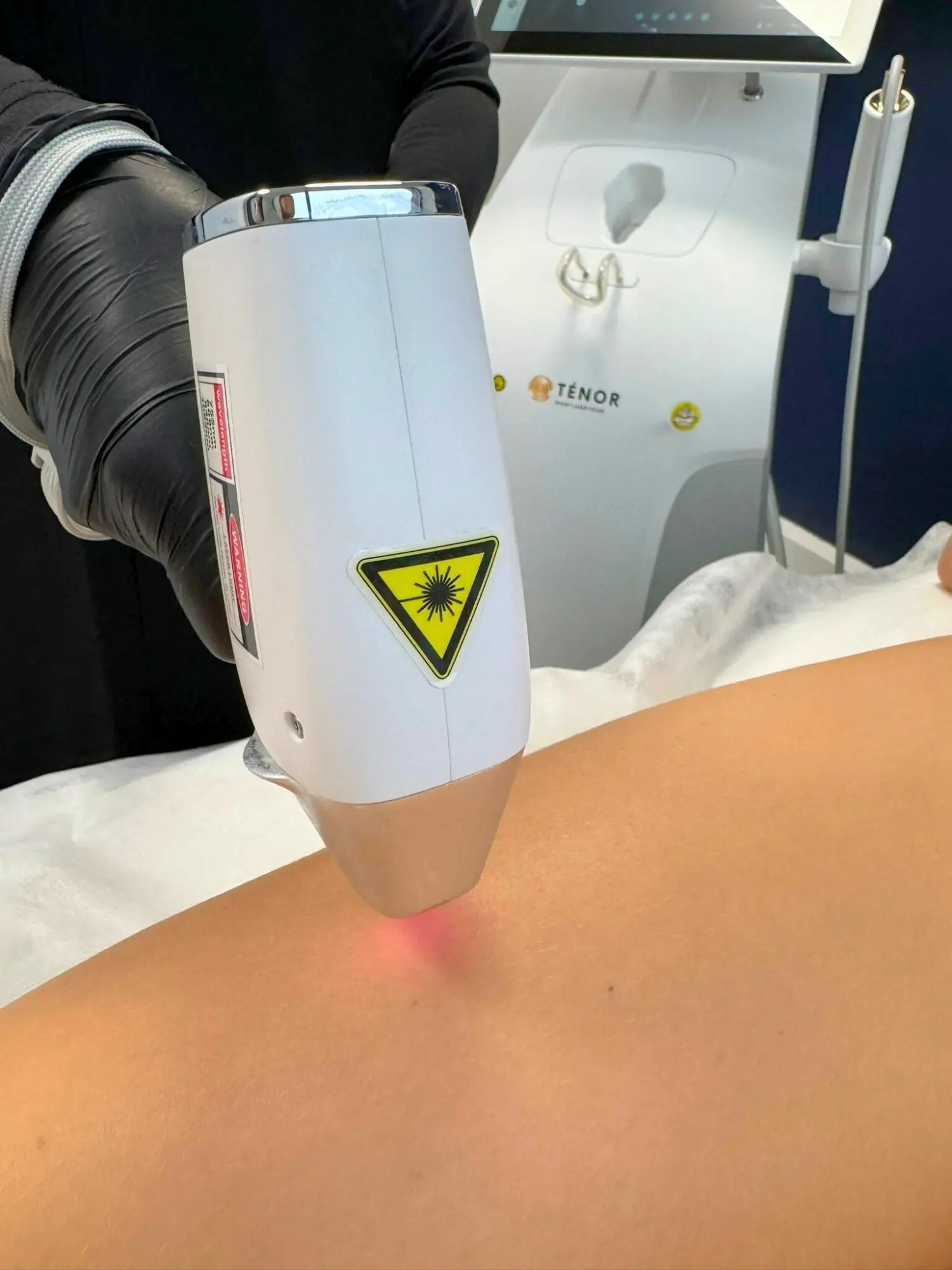 Infirmière IDE pratiquant épilation laser diode phototypes I à VI