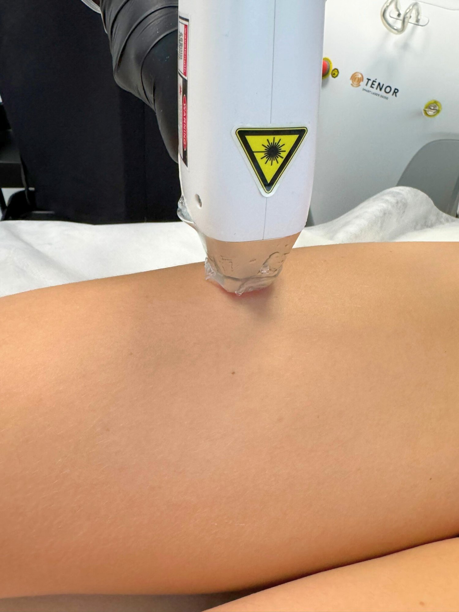 Grossiste laser professionnel — Ténor Smart laser diode vente directe fabricant