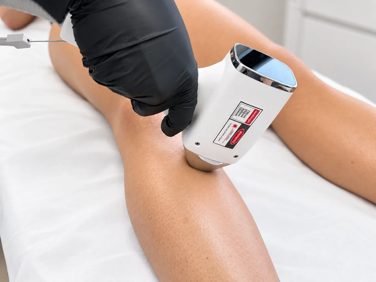 Résultat après la 1ère séance d'épilation laser : à quoi s'attendre ?